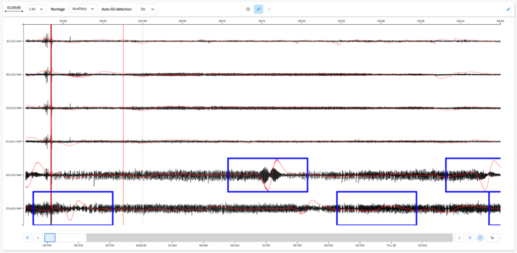 Dr. Jed Hartings' cortical spreading depolarization detection algorithm for real-time use (OpenSD)