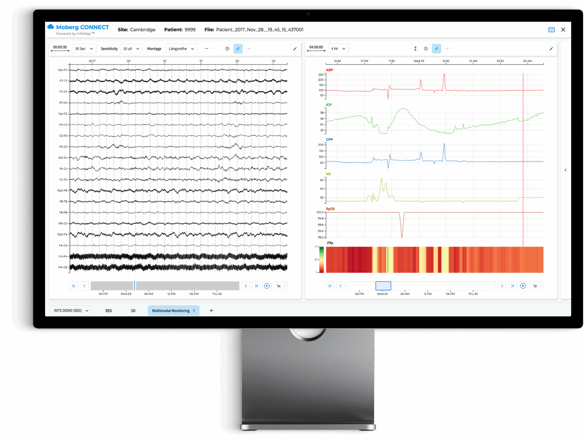 the moberg analytics Moberg Clinical Platform (MCP) Bedside Dashboard: Review Multimodal Data